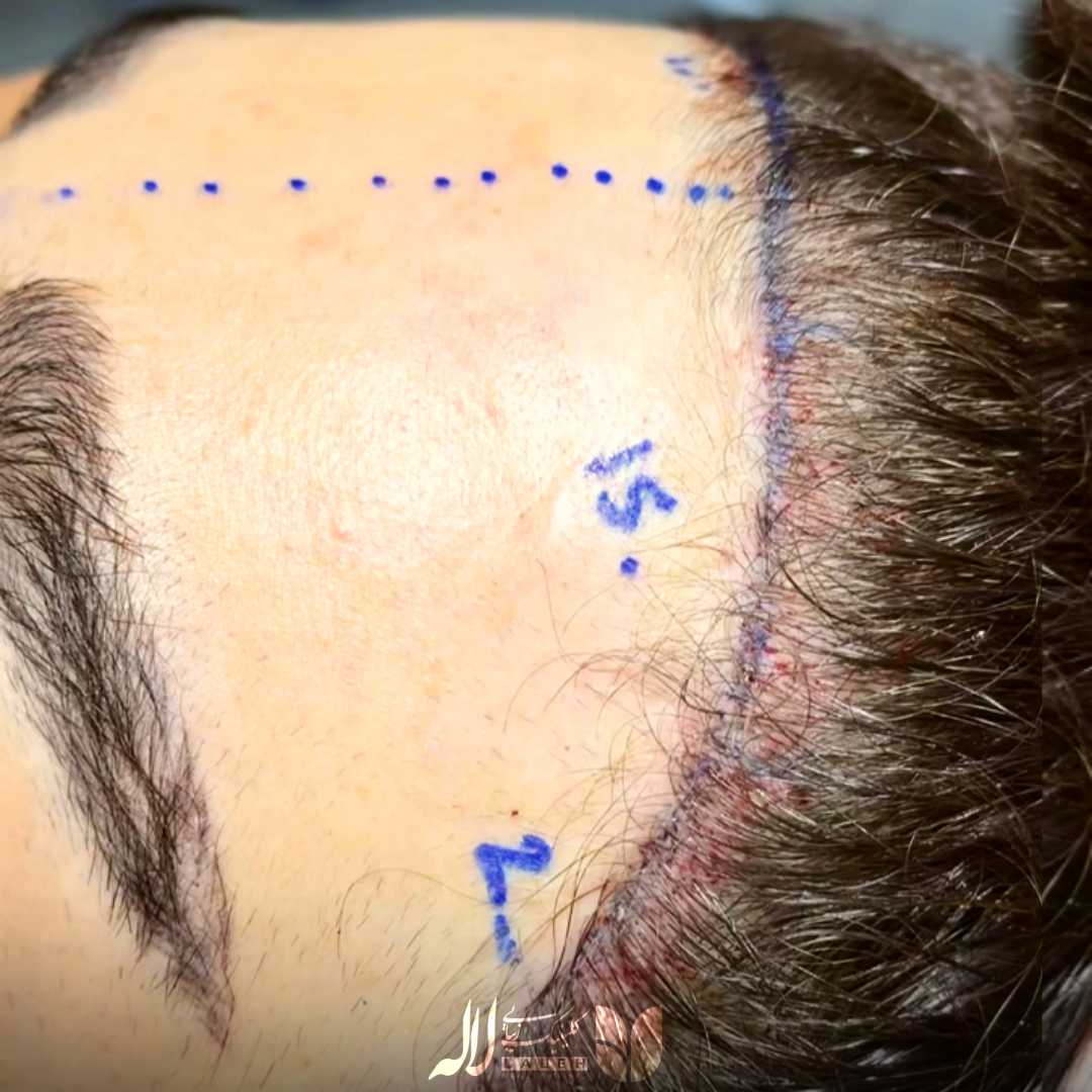 کاشت شقیقه بانوان