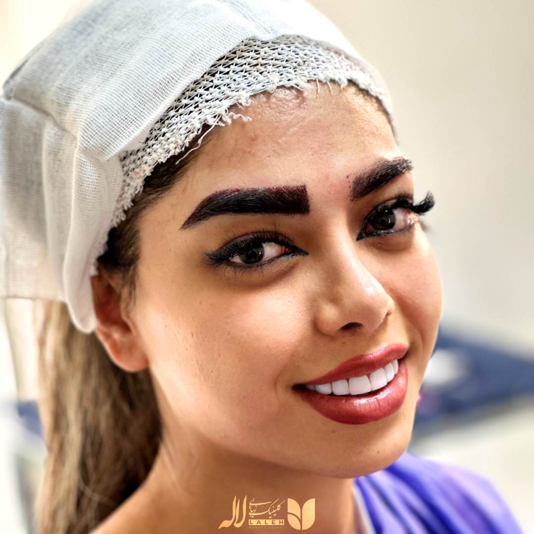 کاشت ابرو دخترونه کلینیک لاله