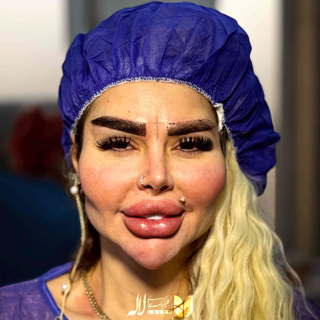 کاشت ابرو کلینیک لاله