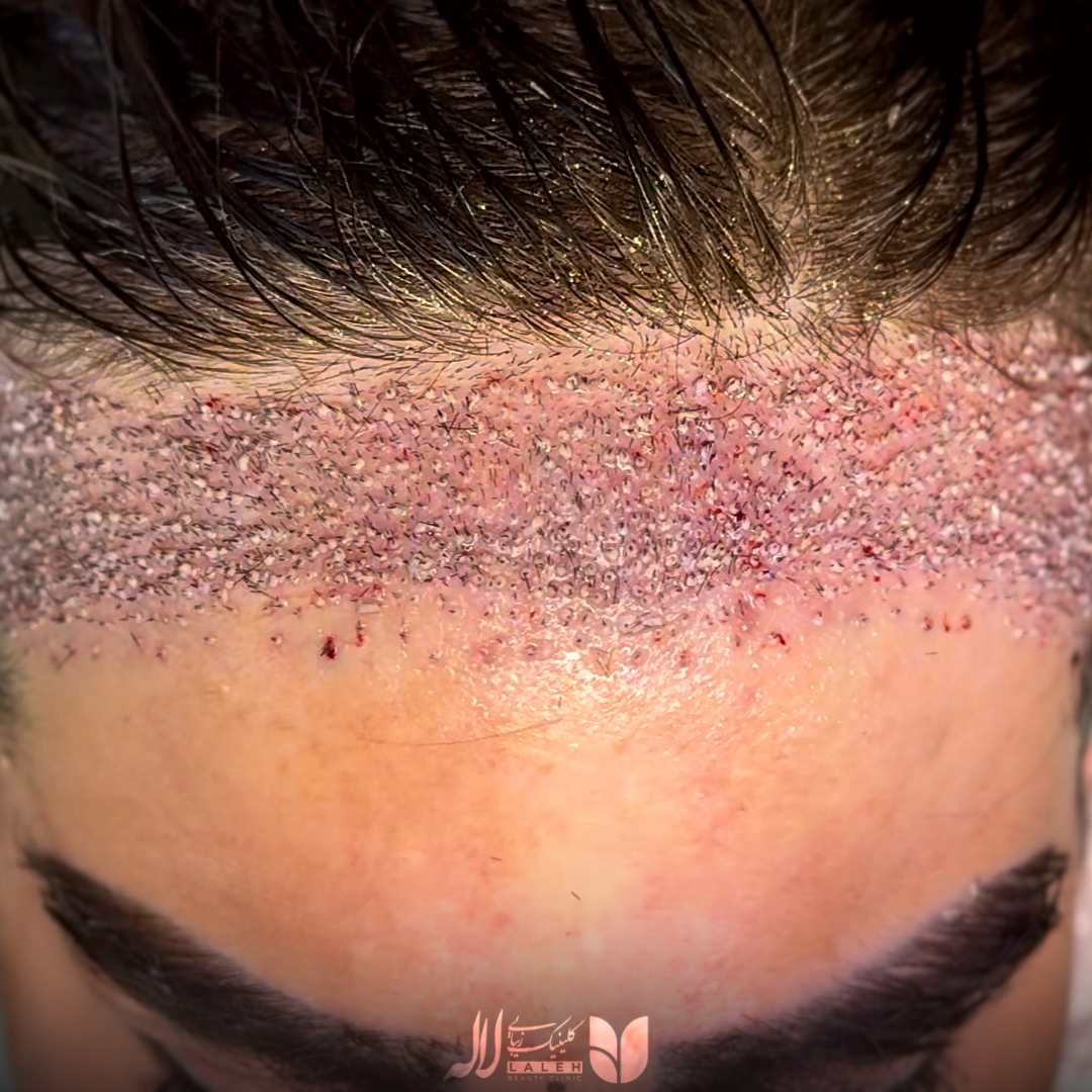 کاشت شقیقه کلینیک لاله