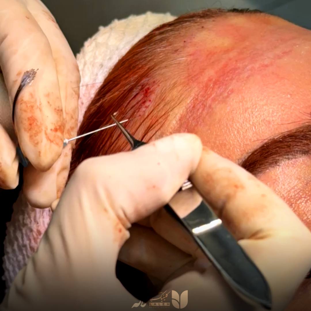 کاشت شقیقه با موی بلند