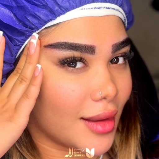 نمونه کاشت ابرو کلینیک لاله