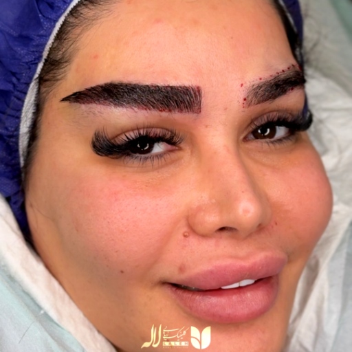 عکس کاشت ابرو پهن
