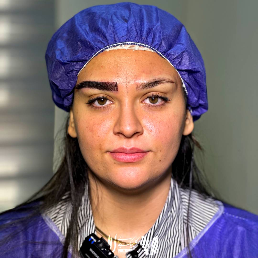 کاشت ابرو سوپرمیکروگرافت