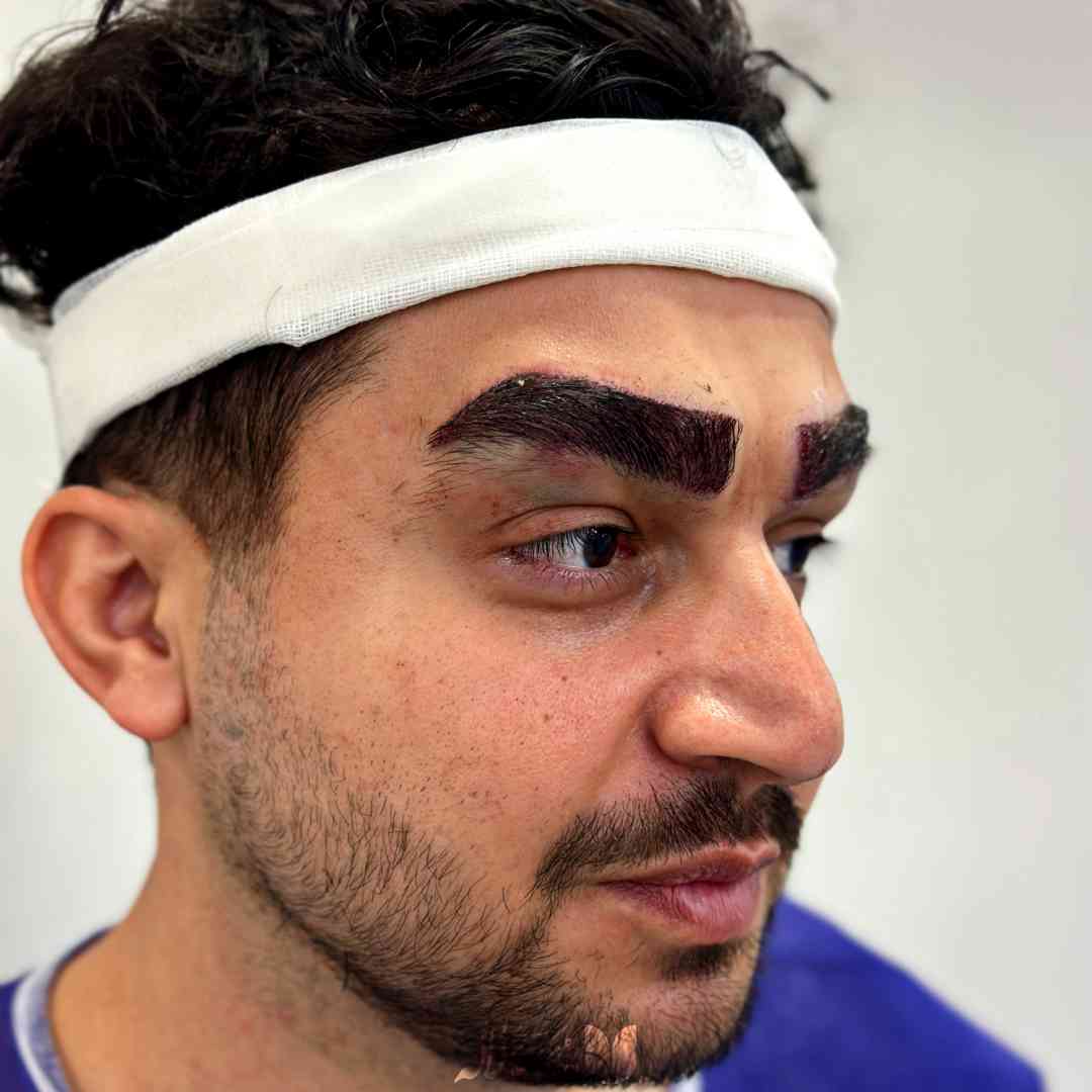 کاشت ابرو آقایان