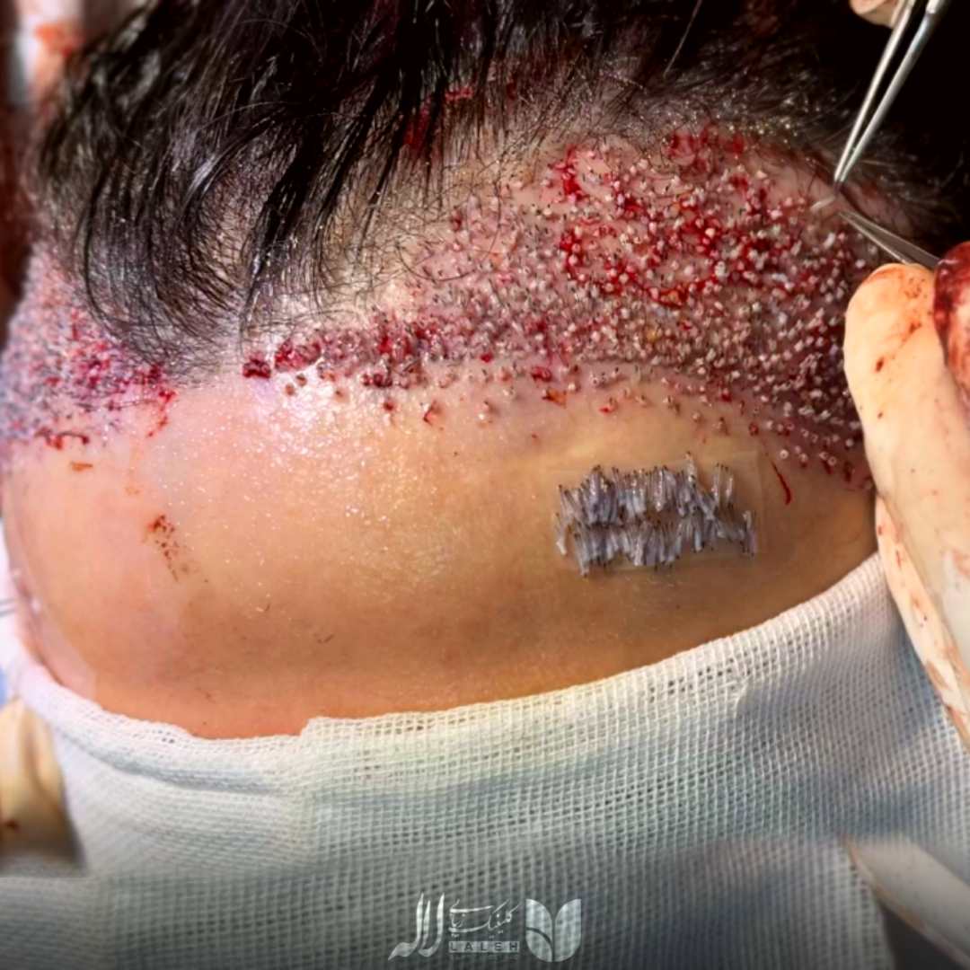 کاشت موی زنانه