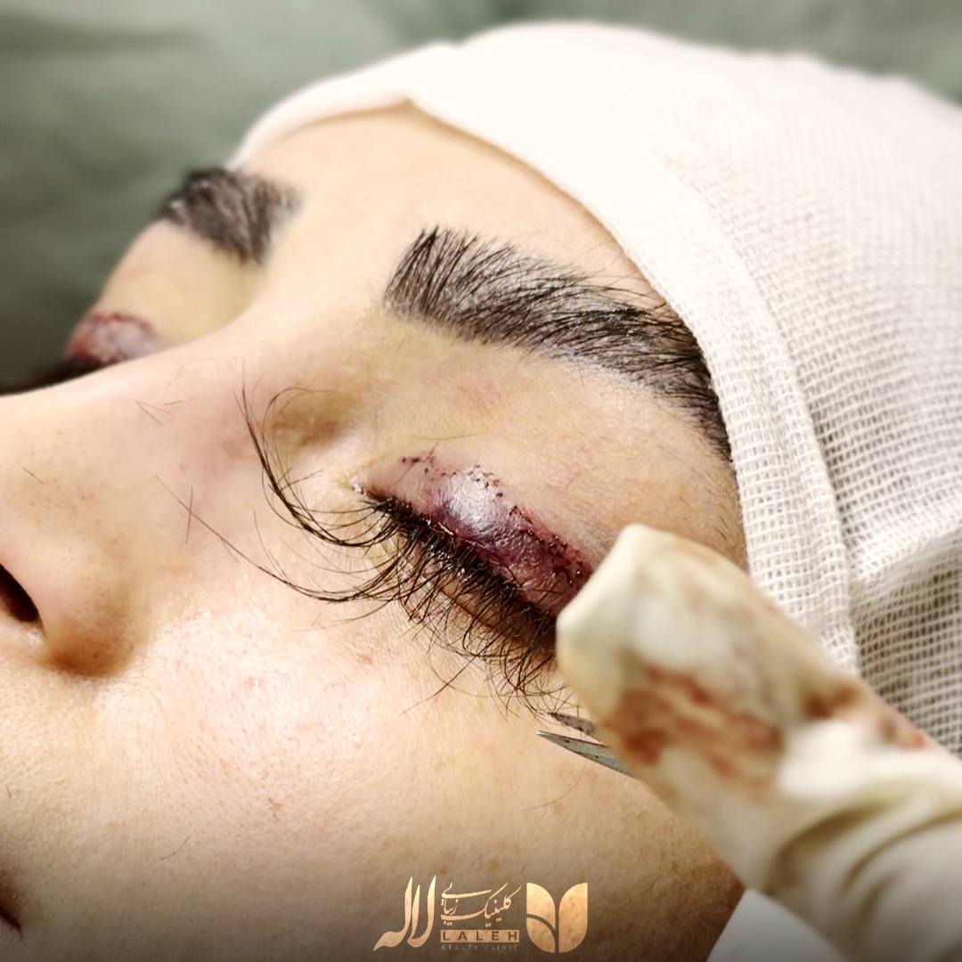 کاشت مژه طبیعی کلینیک لاله