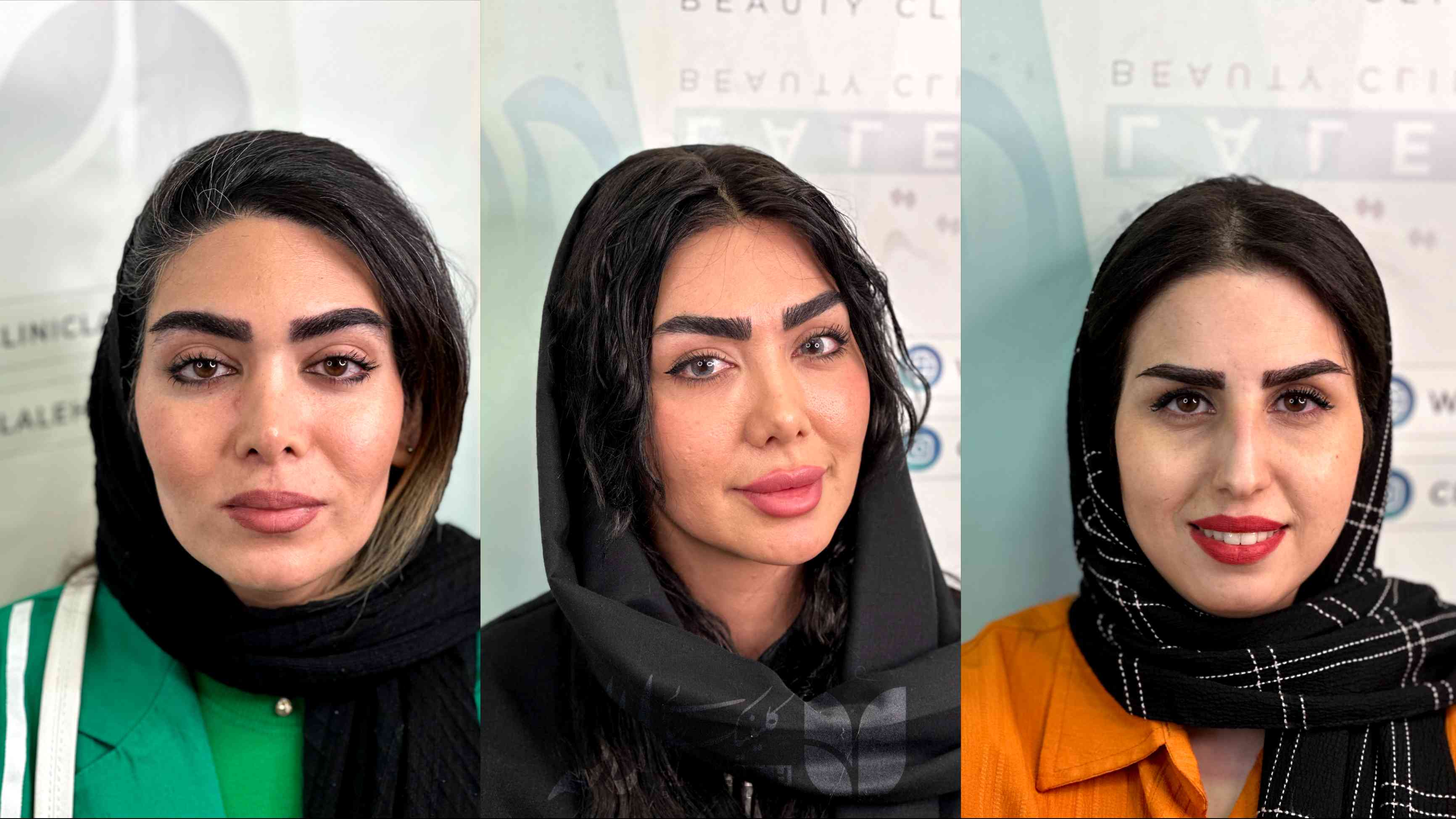 تصاویر کاشت ابرو کلینیک لاله