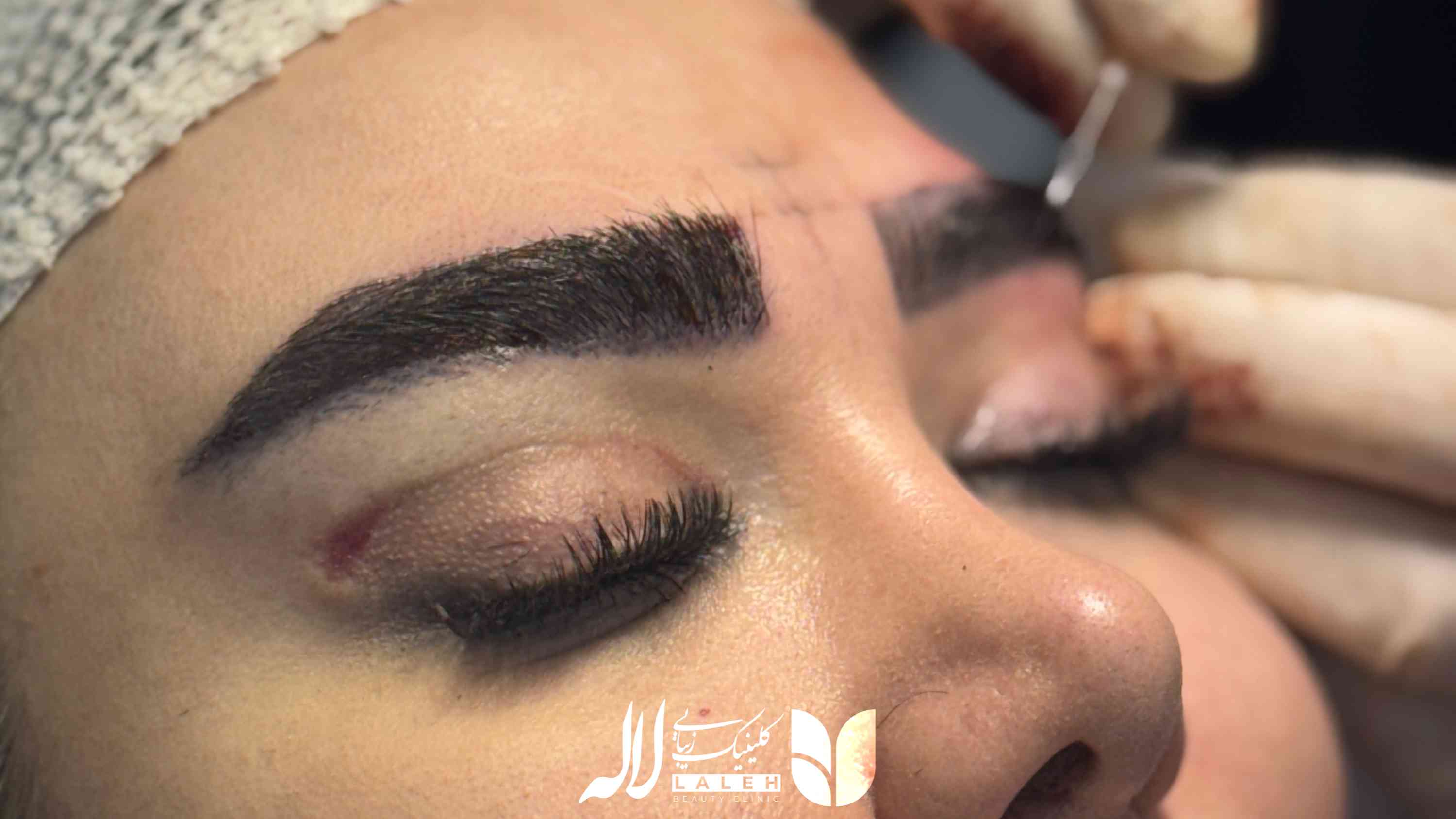 مسواکی شدن ابرو کاشت شده
