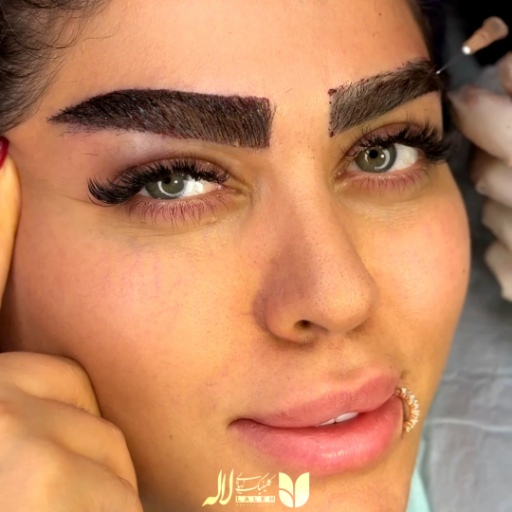 قبل و بعد کاشت ابرو