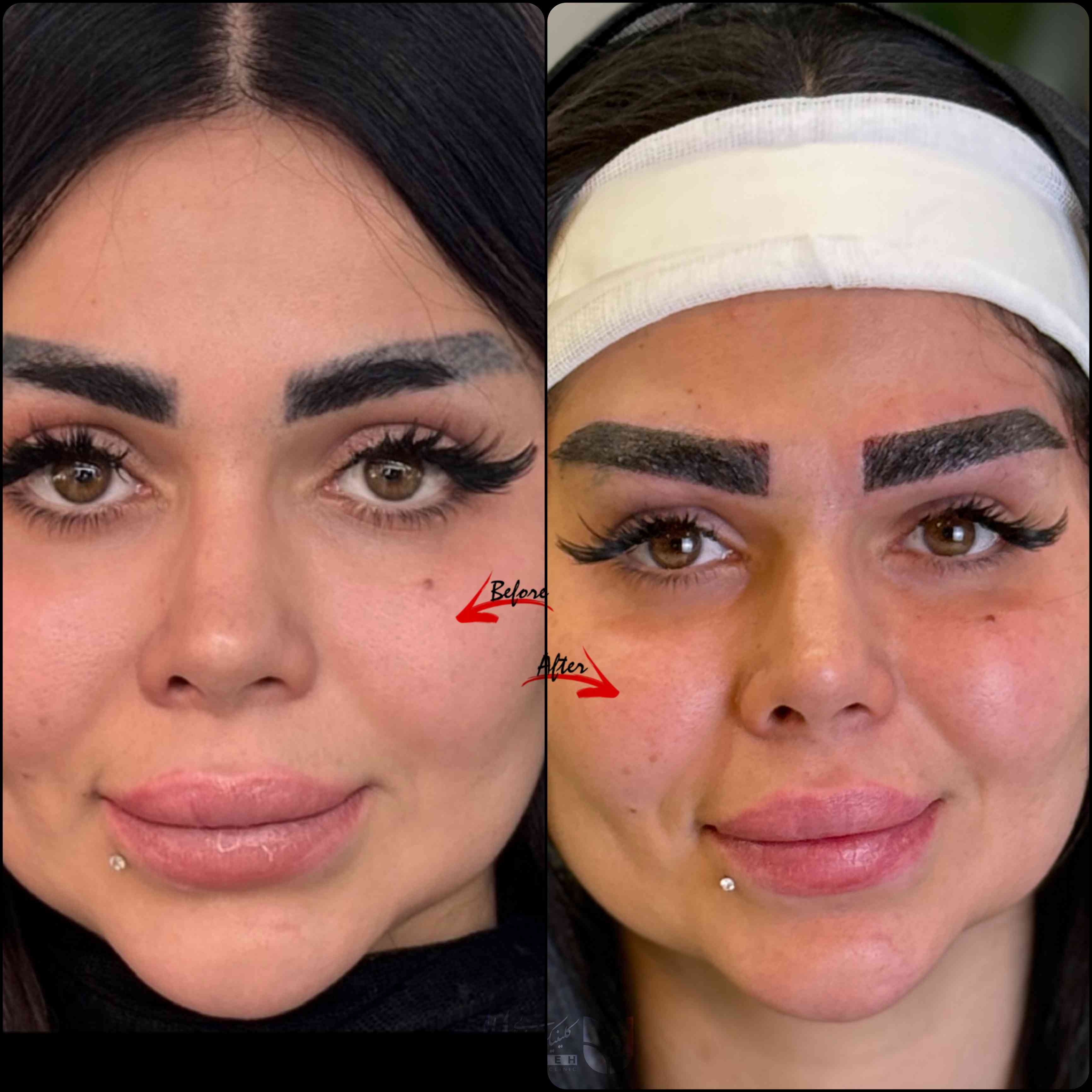 کاشت ابرو کلینیک لاله