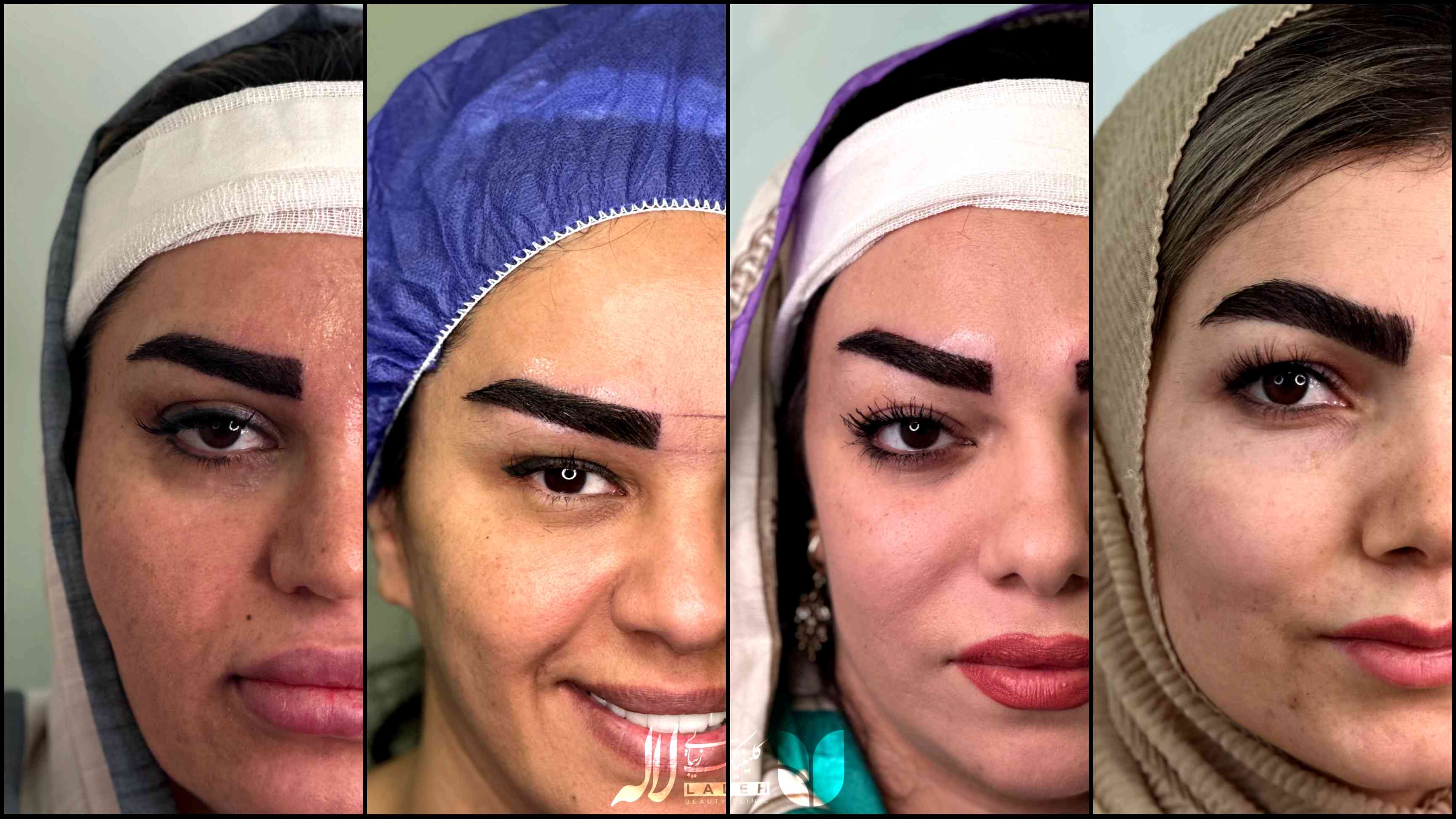کاشت ابرو در کلینیک لاله