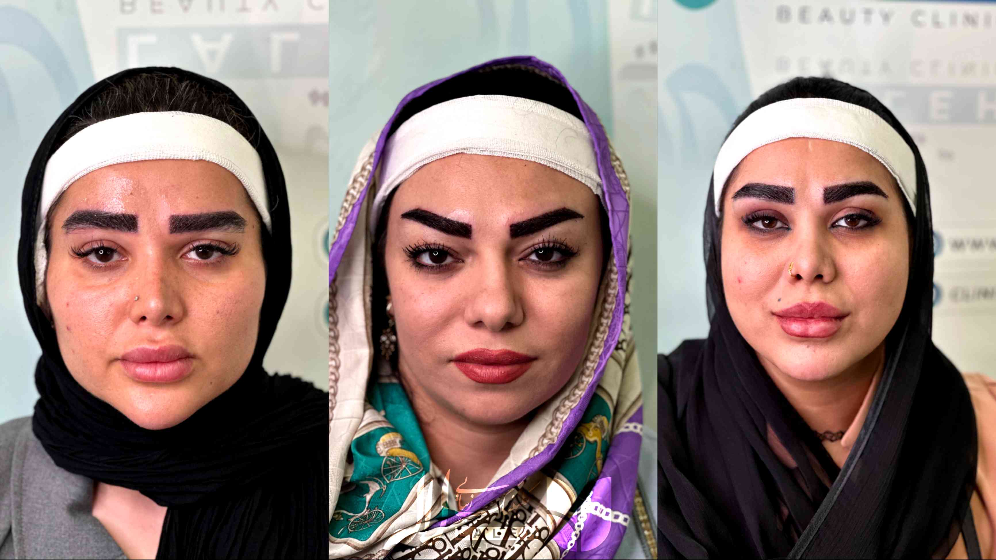 تصاویر کاشت ابرو طبیعی