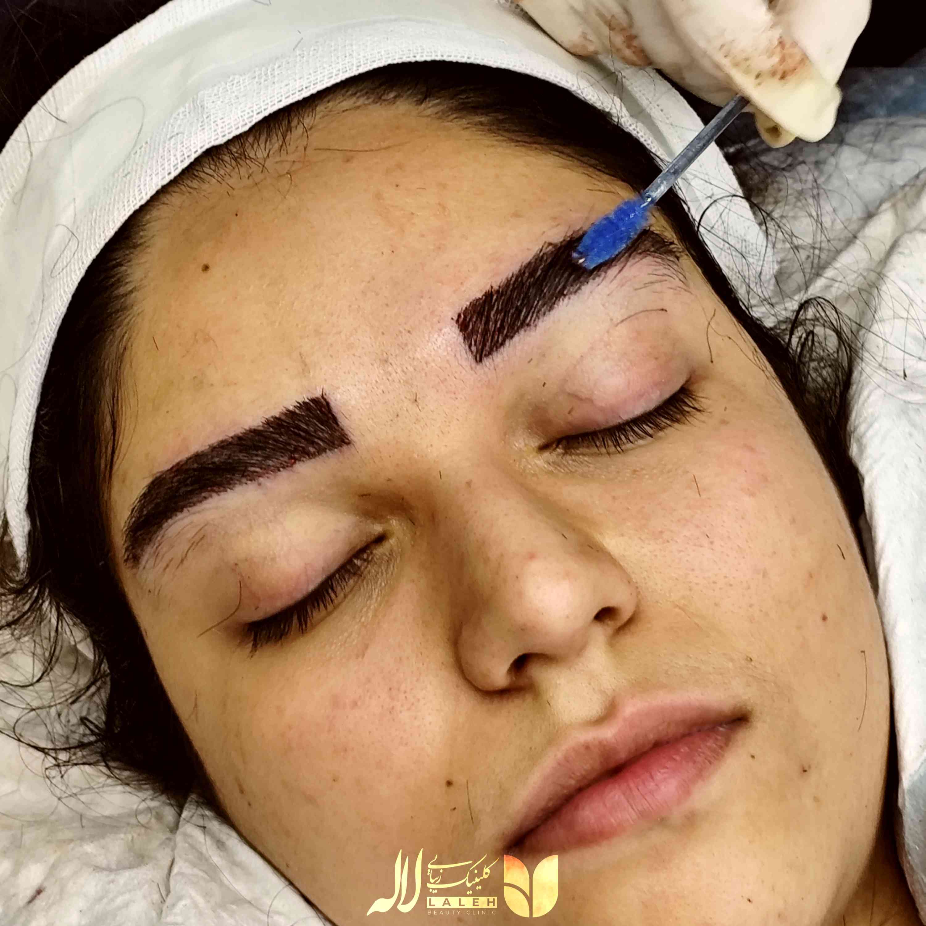 کاشت ابرو با زیر ابرو کلینیک لاله