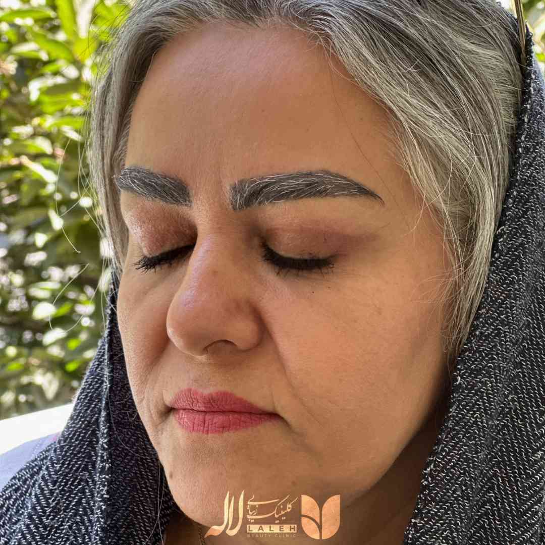 عکس ریزش ابرو بعد از کاشت