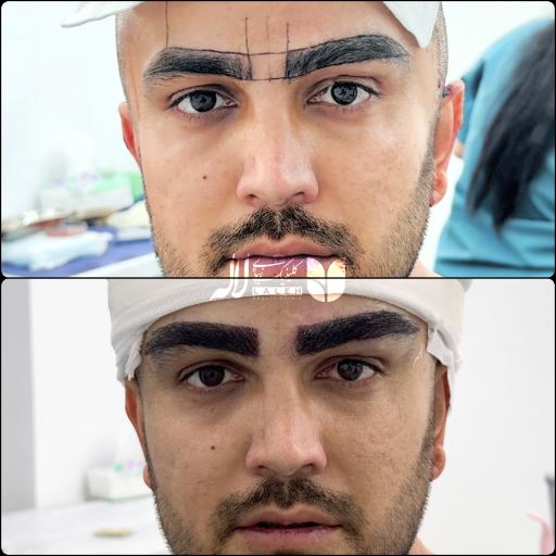 کاشت ابرو آقایان