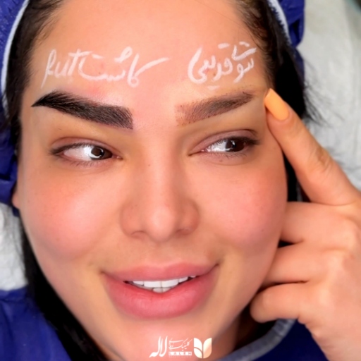 بهترین کلینیک کاشت ابرو