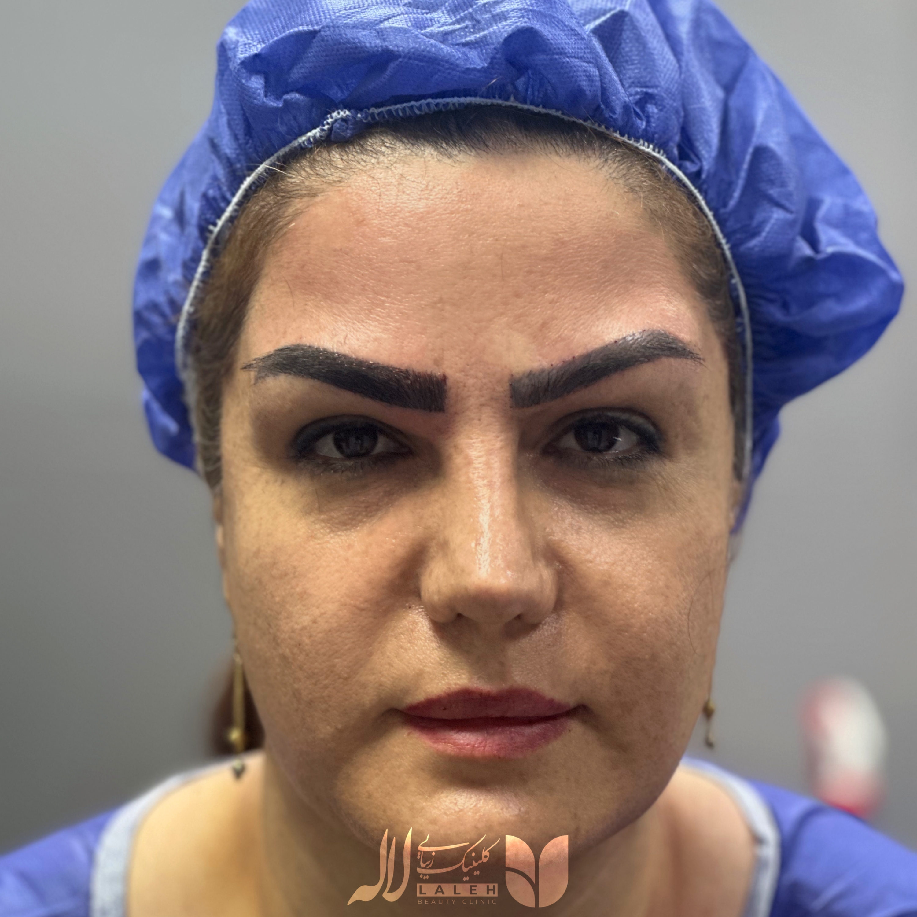 عکس ریزش ابرو بعد از کاشت