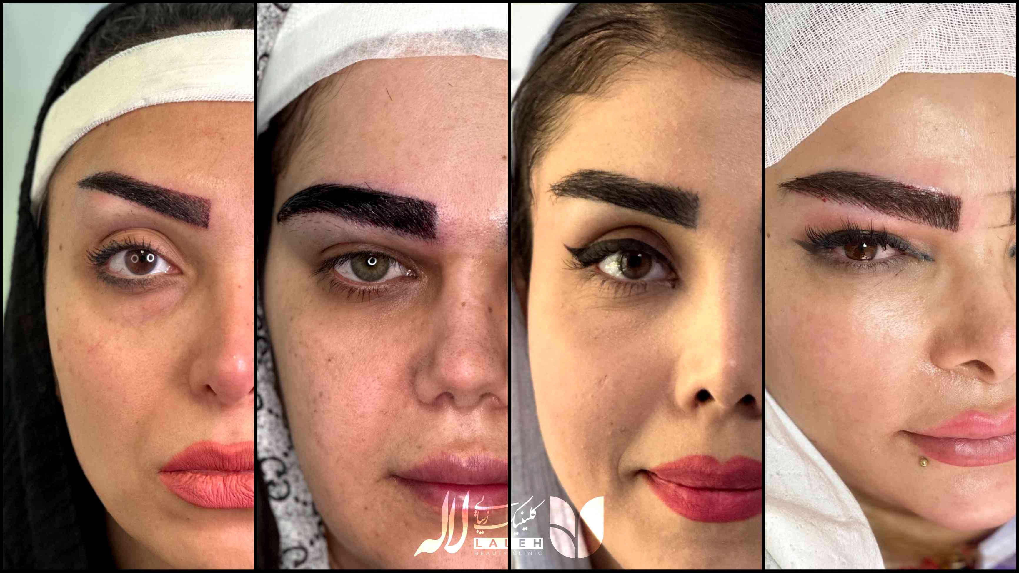 کاشت ابرو کلینیک لاله
