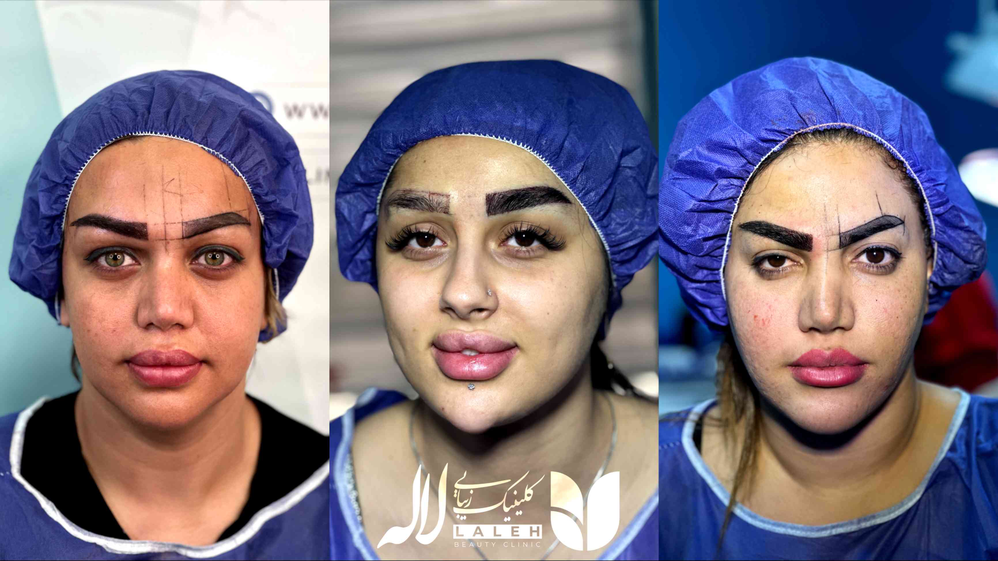 قبل و بعد کاشت ابرو کلینیک لاله