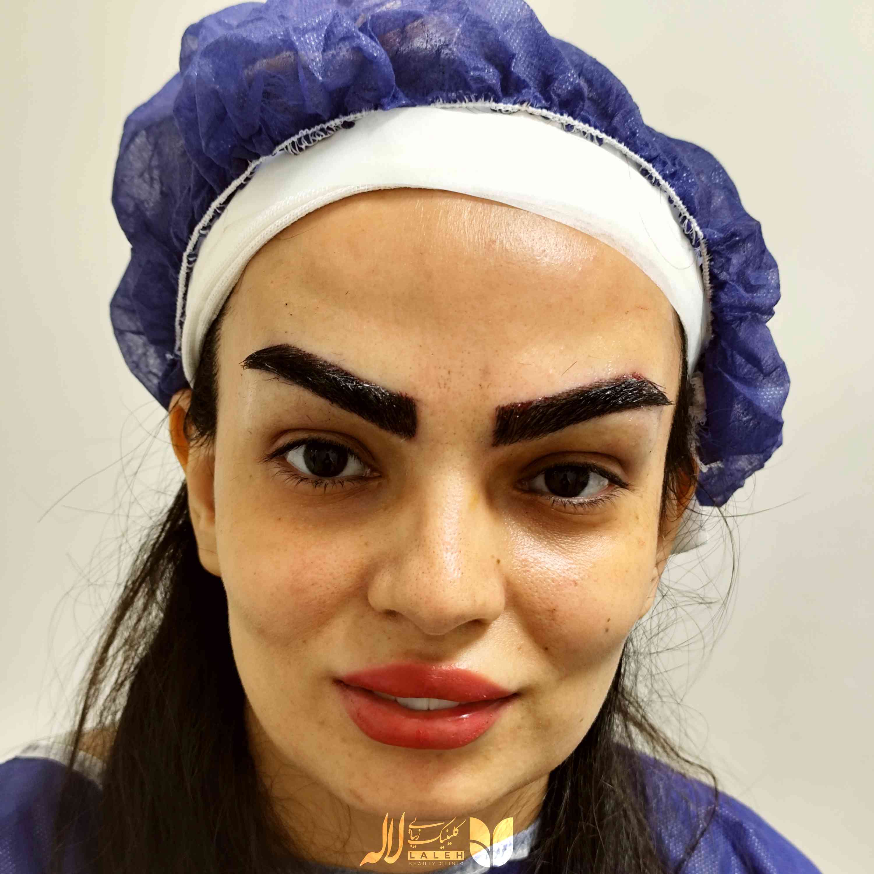 کاشت شقیقه کلینیک لاله
