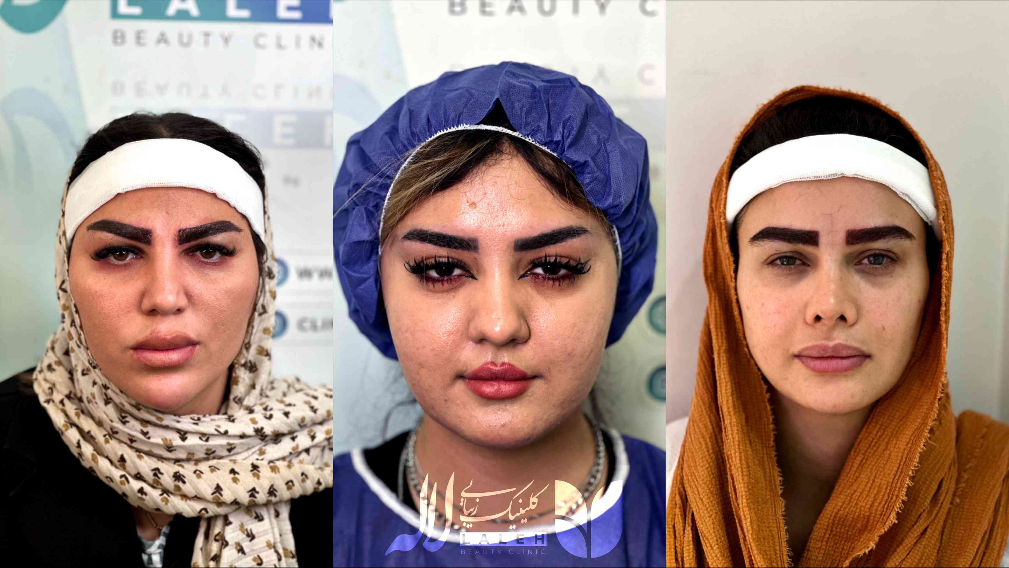 نمونه کاشت ابرو کلینیک لاله