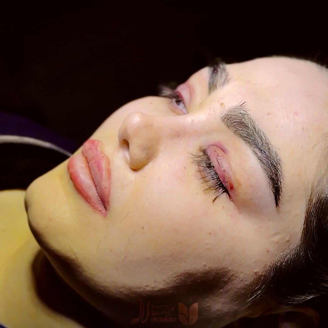عکس کاشت مژه دائمی با جراحی