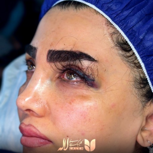 جراحی کاشت مژه طبیعی