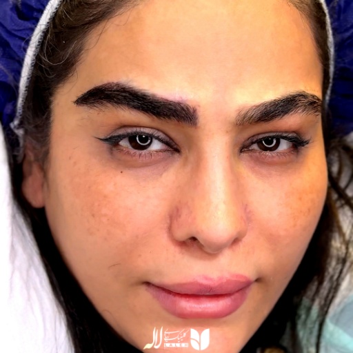 کاشت ابرو طبیعی