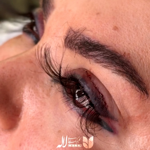 عکس عمل پیوند مژه