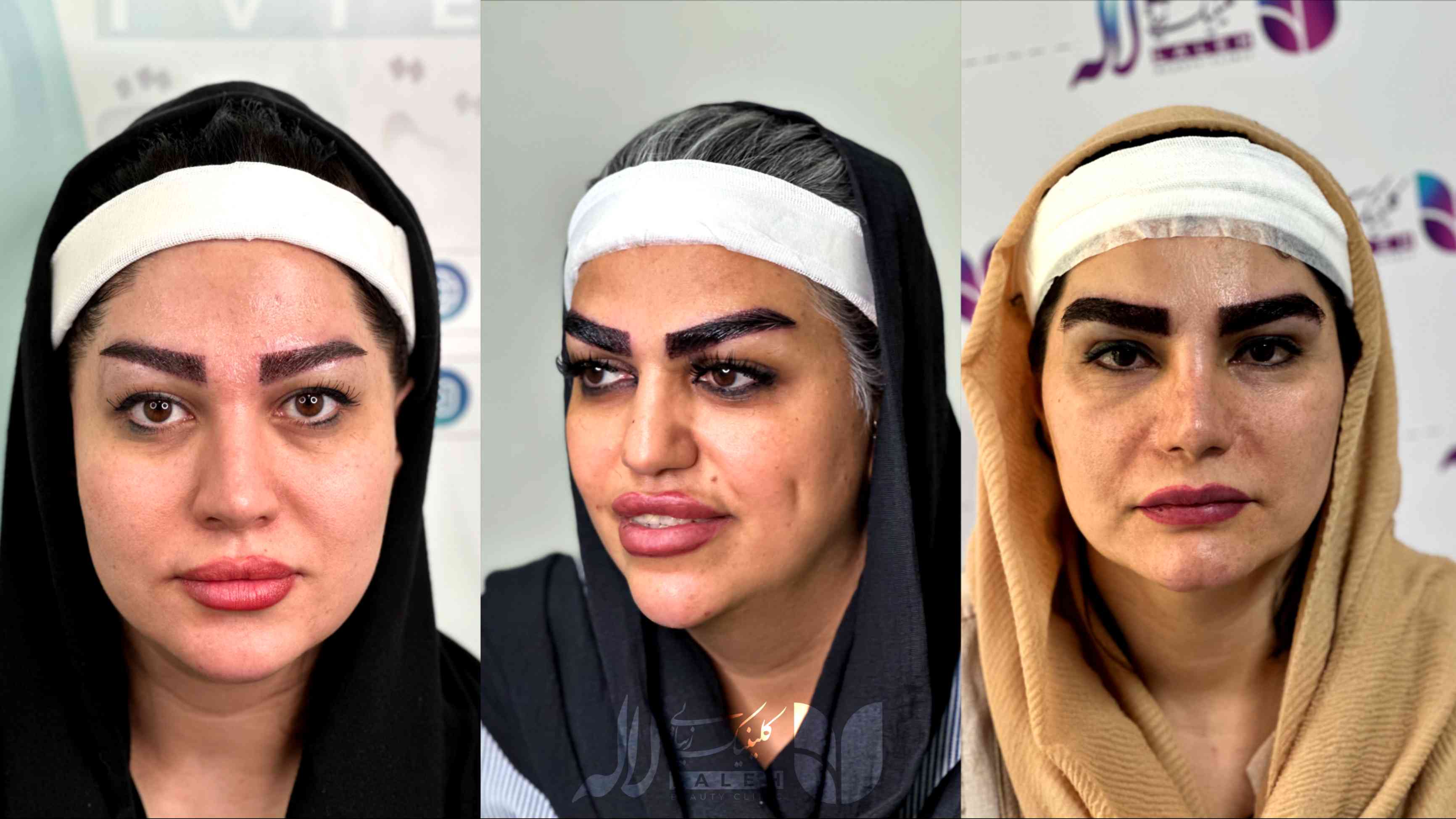 کاشت ابرو با موی سفید