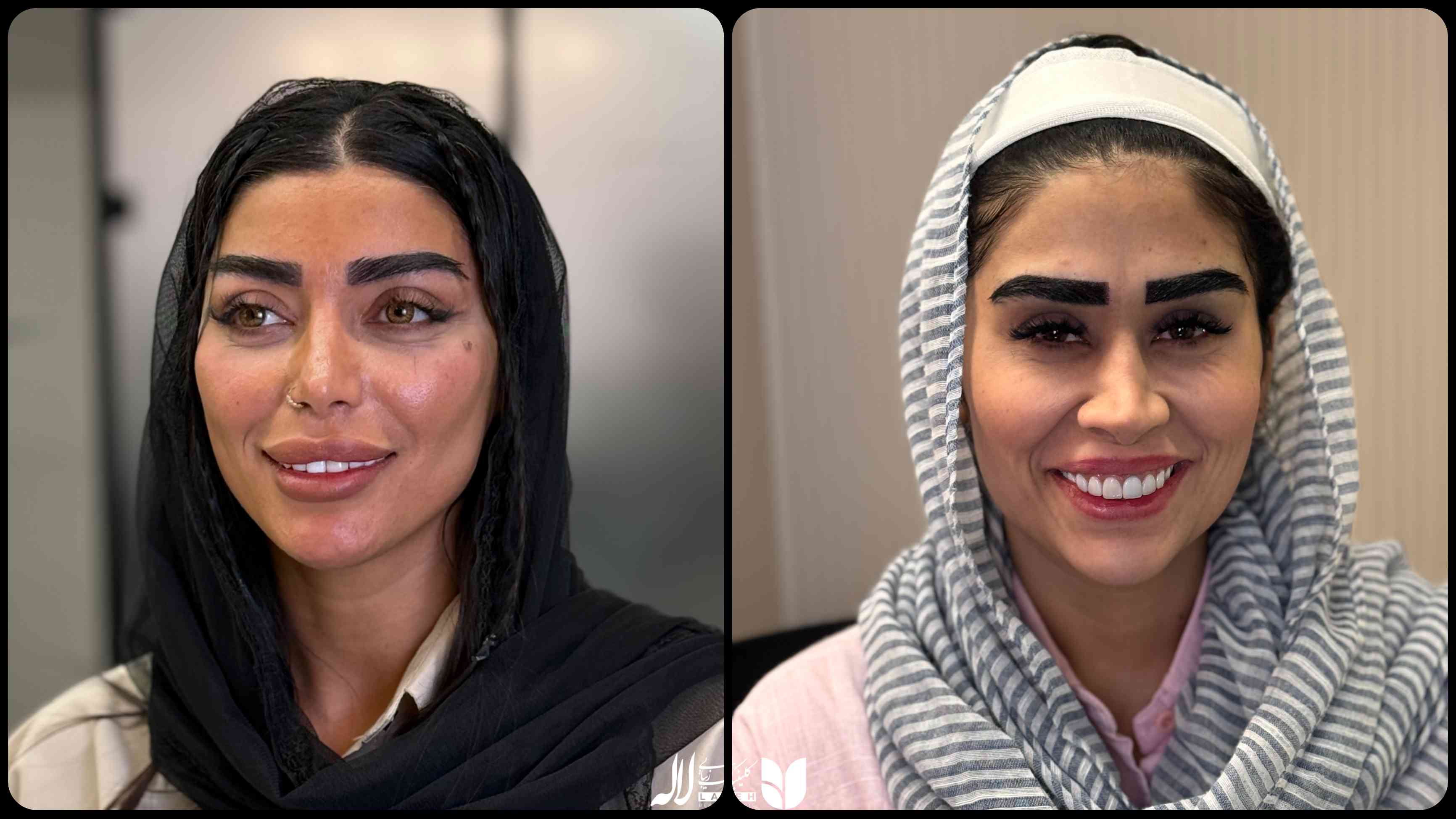 کاشت ابرو بعد از یکسال کلینیک لاله