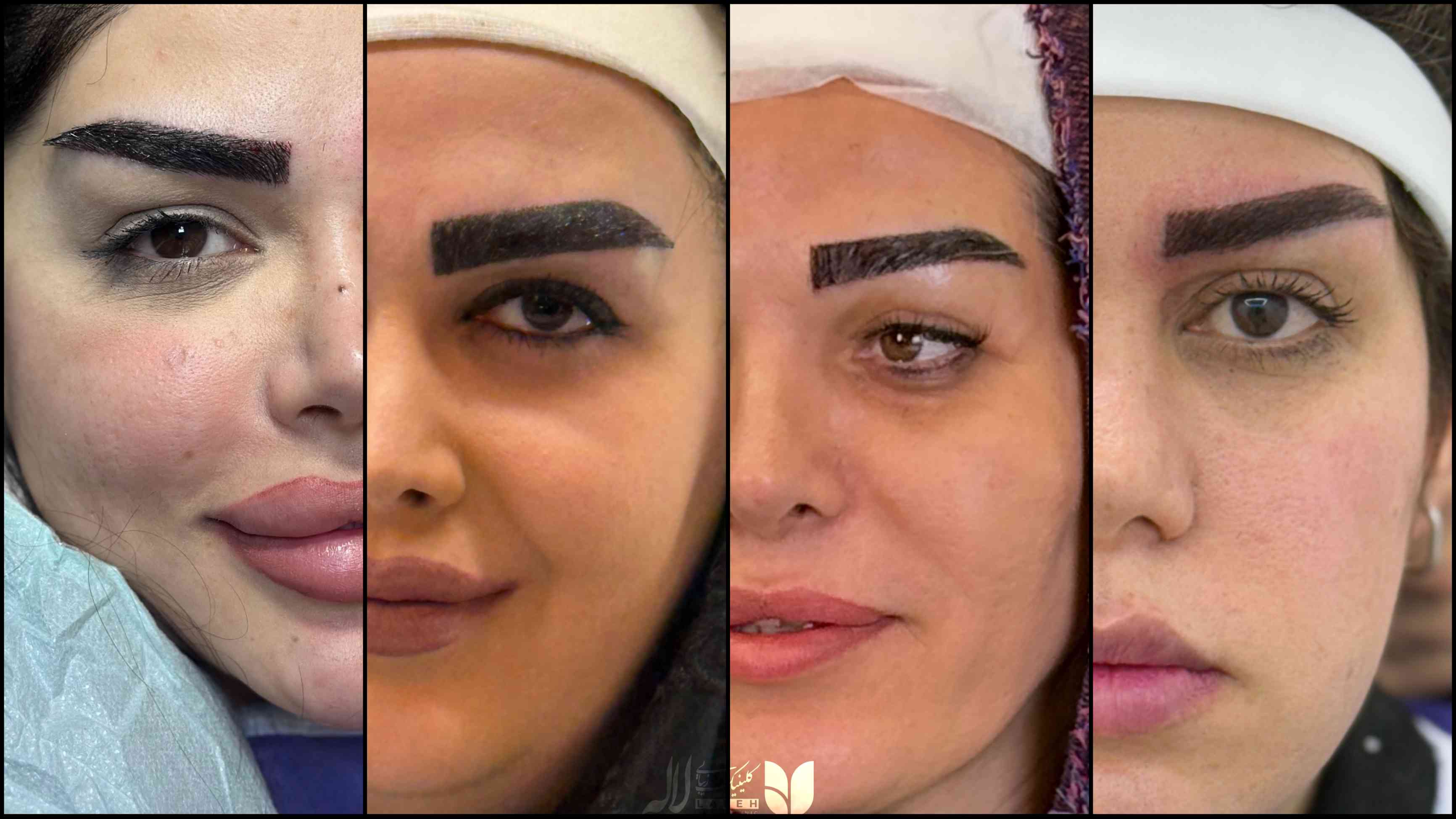بهترین روش کاشت ابرو کلینیک لاله