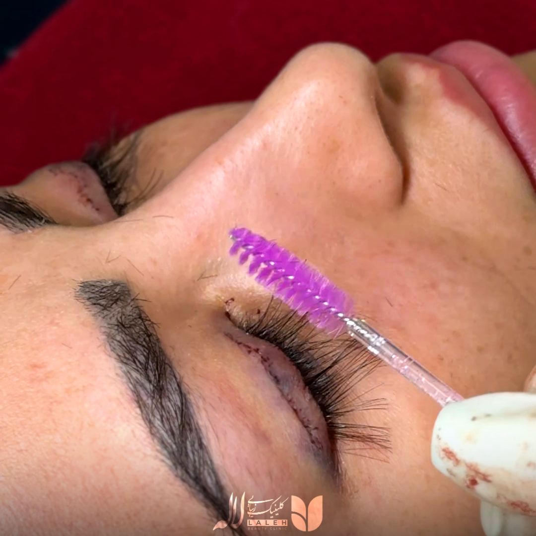 عکس کاشت مژه با جراحی