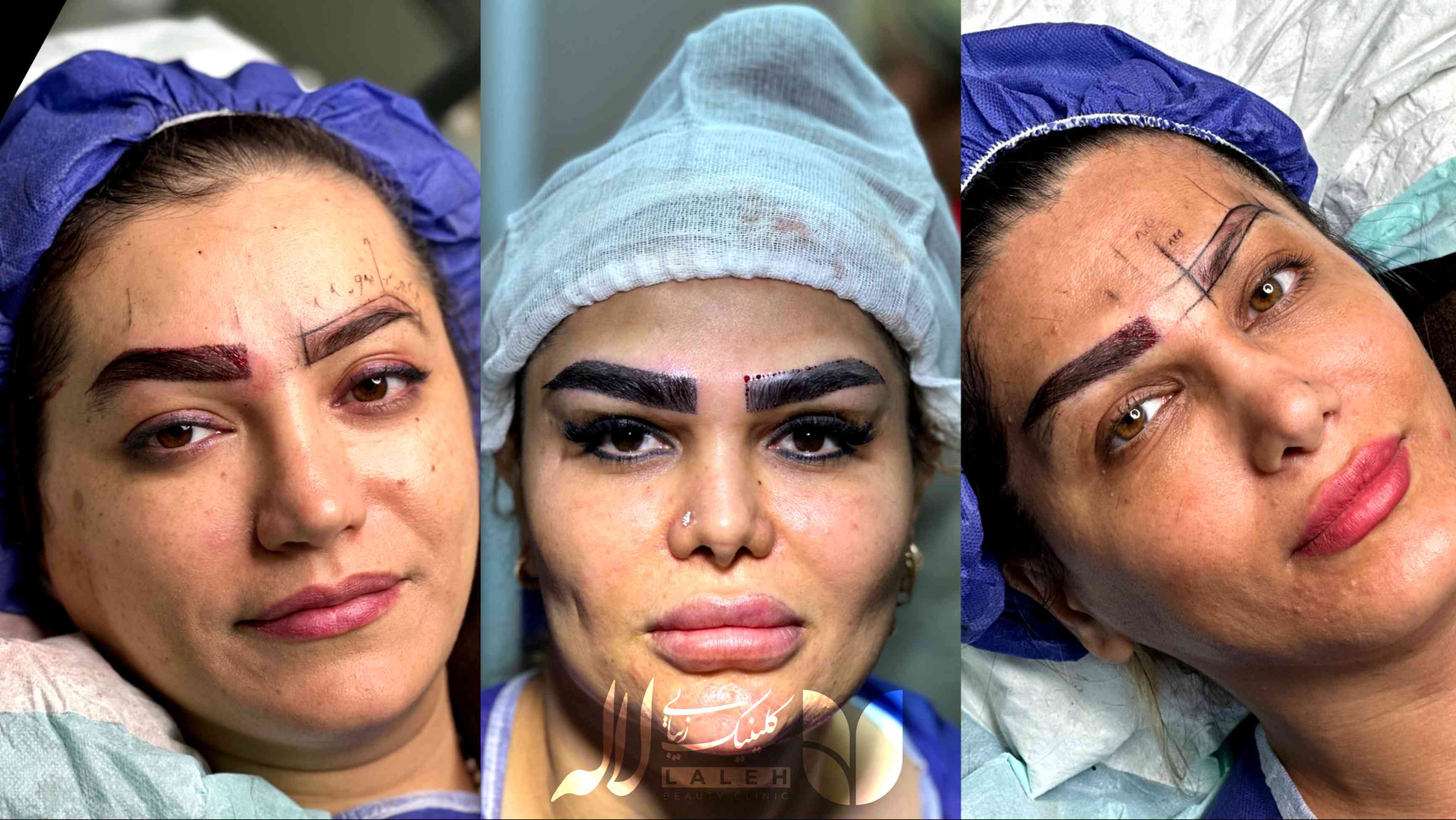 بیماری هایی که باعث ریزش ابرو میشه