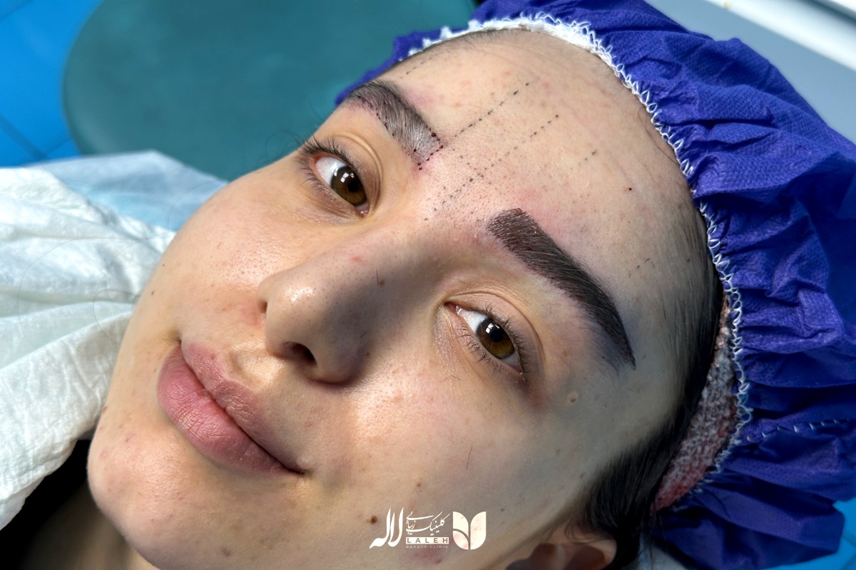 نمونه کاشت ابرو ناموفق