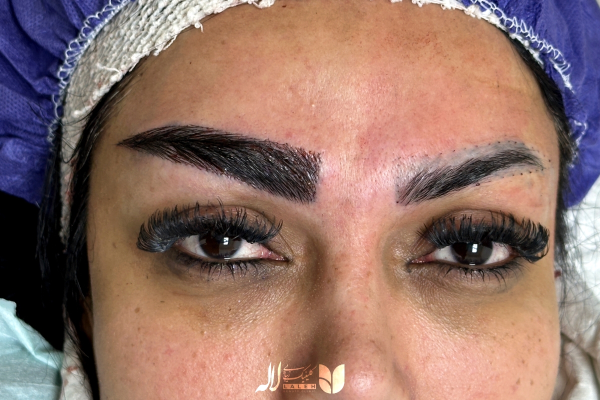 ترمیم کاشت ابرو ناموفق قبل و بعد
