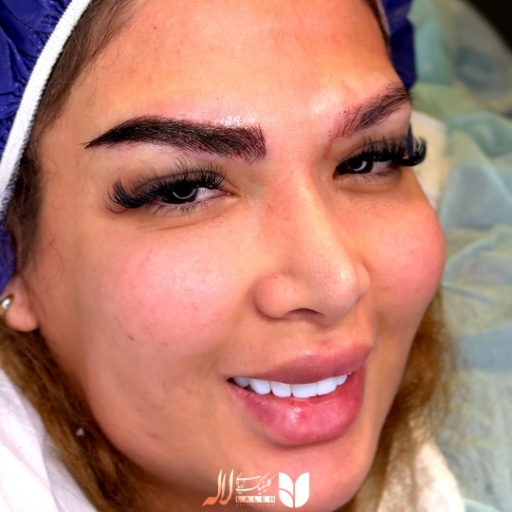 تصویر کاشت ابرو