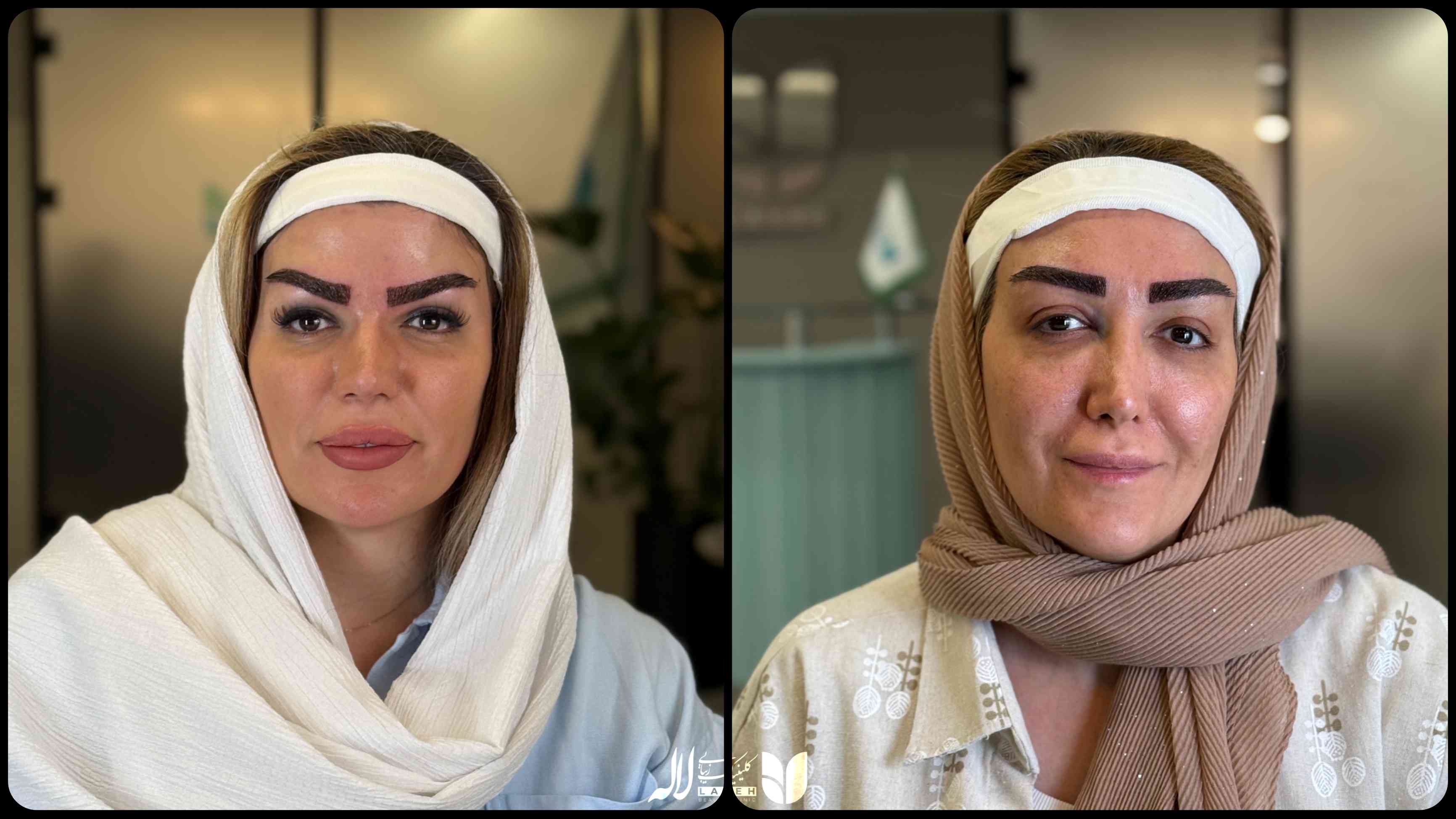 تصویر کاشت ابروی نچرال