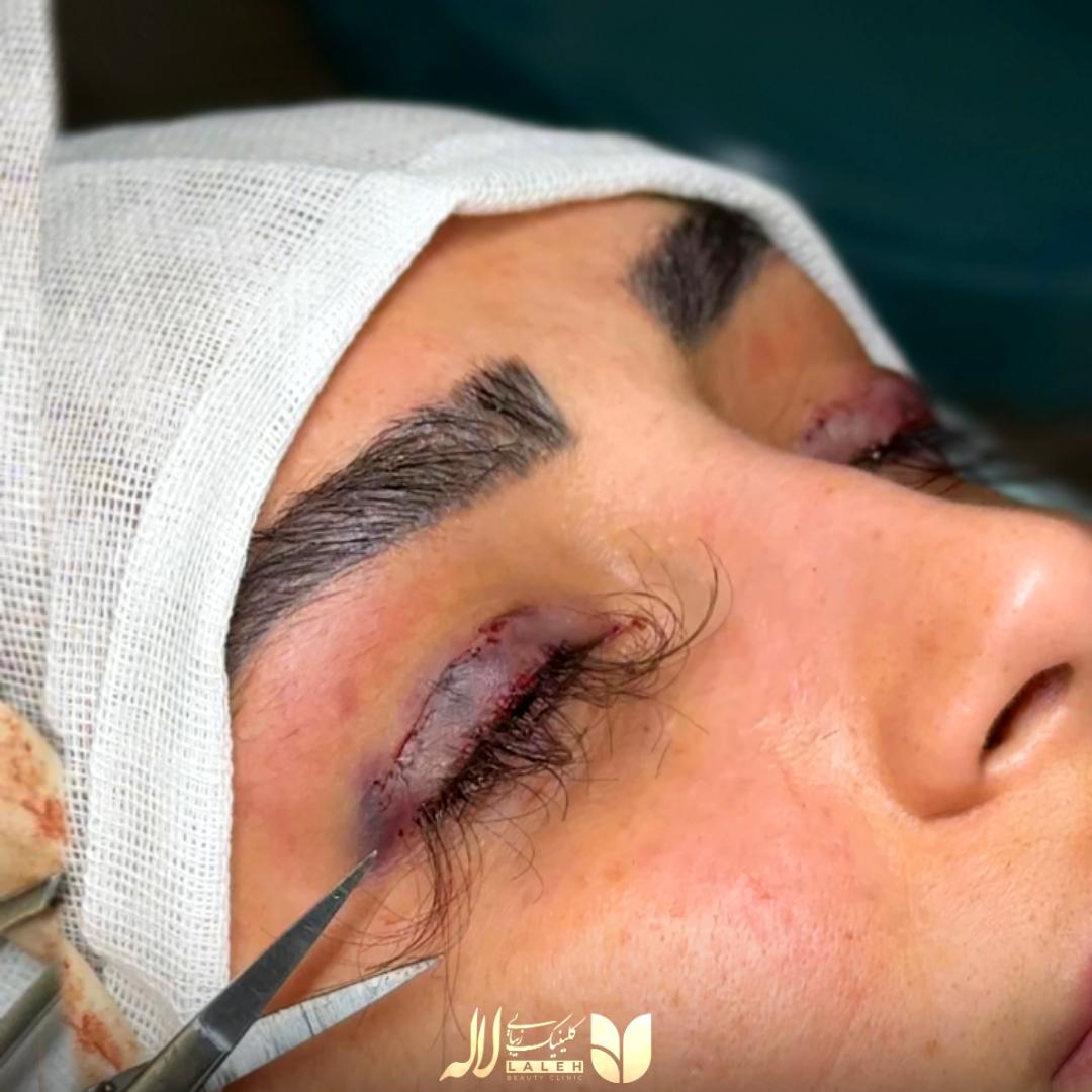 کاشت مژه با جراحی کلینیک لاله