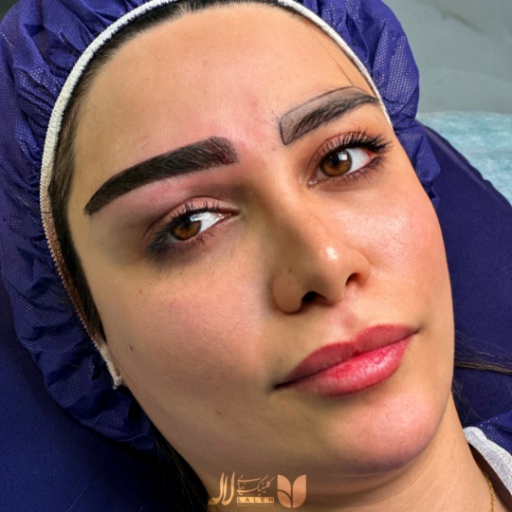 بهترین دکتر کاشت ابرو در تهران - نمونه کار قبل و بعد