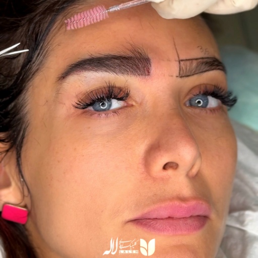 نمونه کاشت ابرو در کلینیک لاله