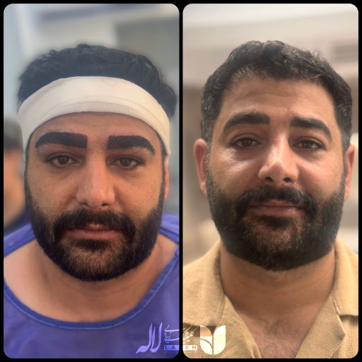 عکس کاشت ابرو مردانه