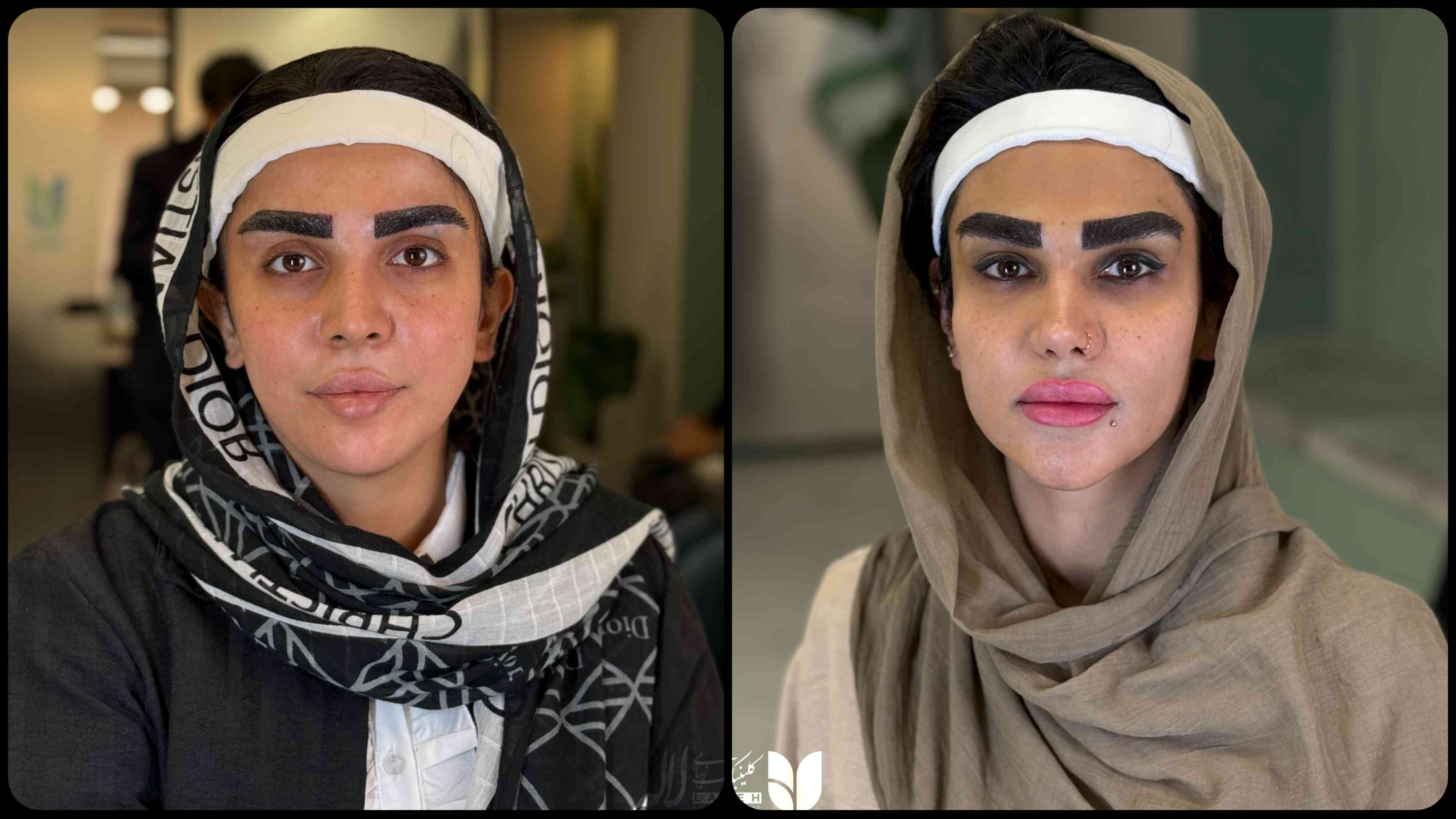 کاشت ابروی پرپشت کلینیک لاله
