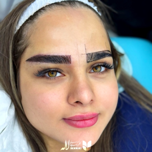 طراحی ابرو قبل از کاشت توسط پزشک متخصص