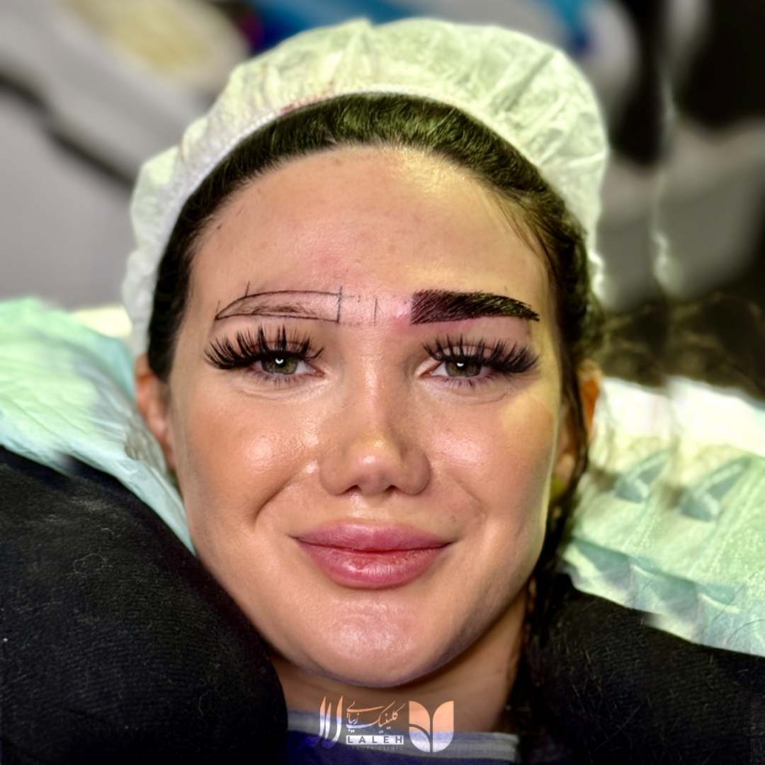 کاشت ابرو بدون جراحی کلینیک لاله