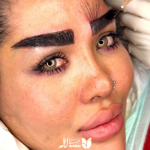 عکس کاشت ابرو