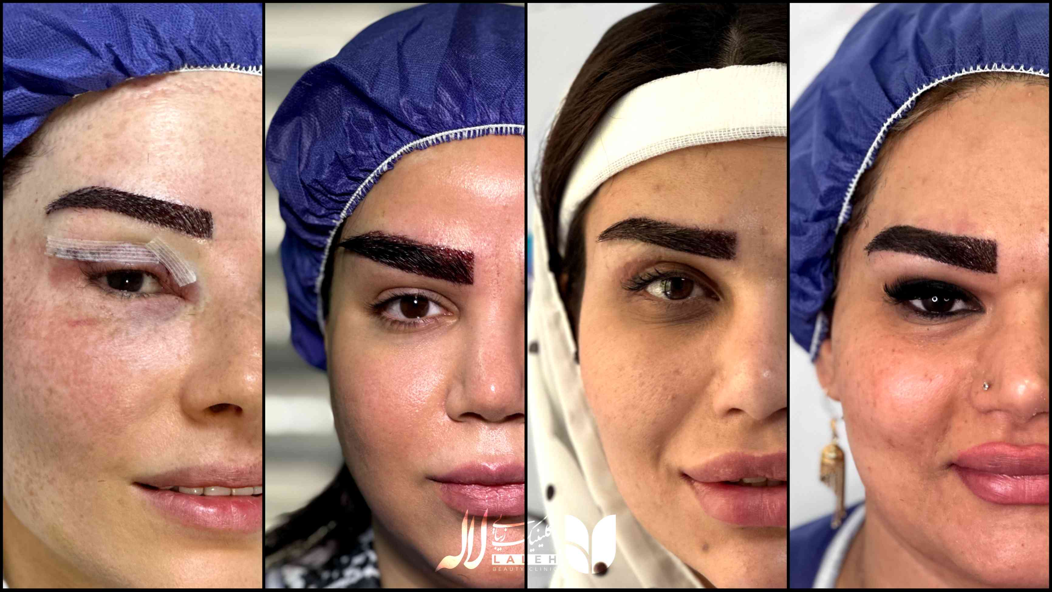 تاثیر دخانیات روی کاشت ابرو
