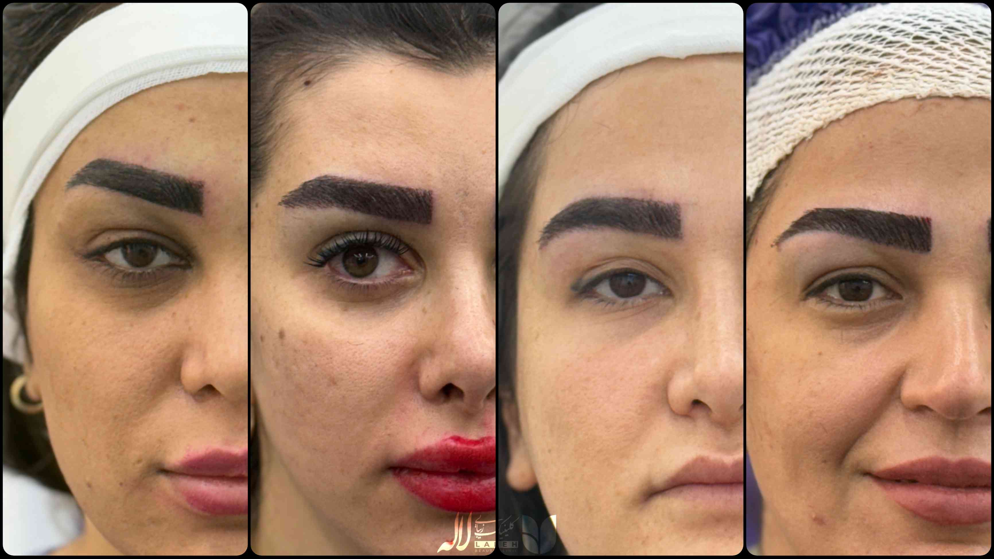 بهترین پزشک کاشت ابرو تهران