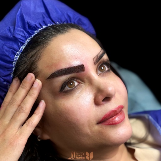 کاشت ابرو تهران